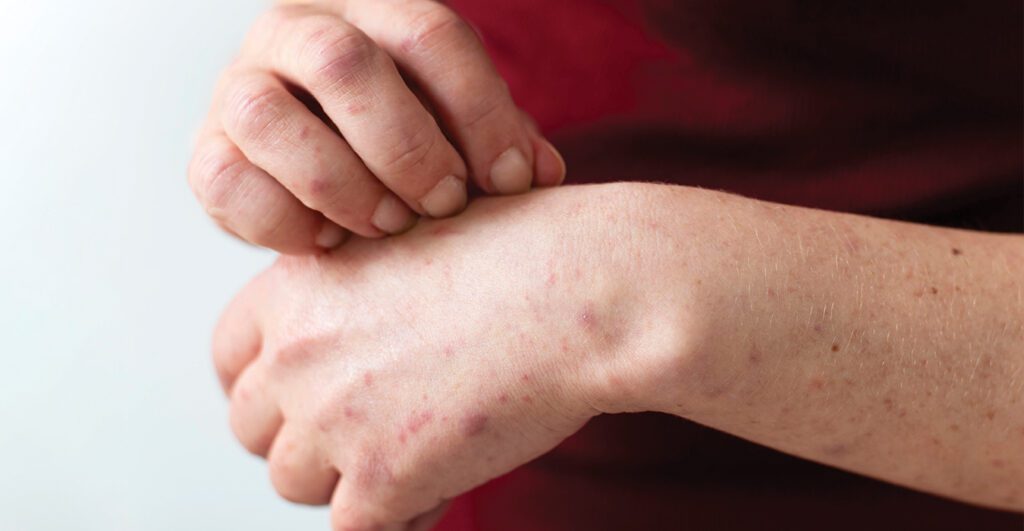 Book Services 15 impetigo1