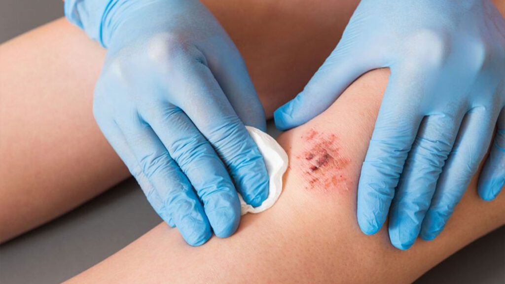 Solaraze Gel for Wound Healing and Skin Regeneration: How It Works 1 Solaraze Gel 1