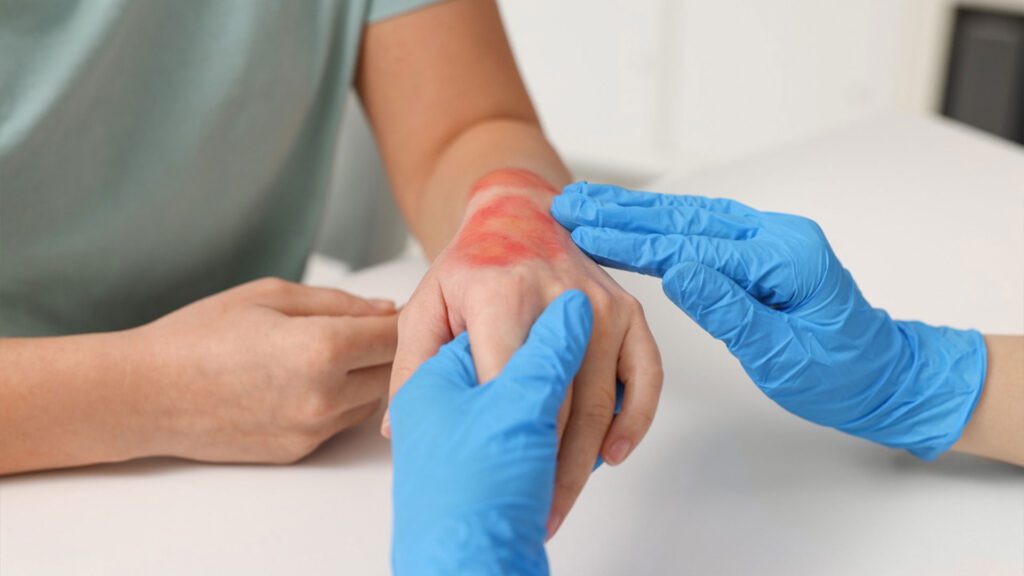 Solaraze Gel for Wound Healing and Skin Regeneration: How It Works