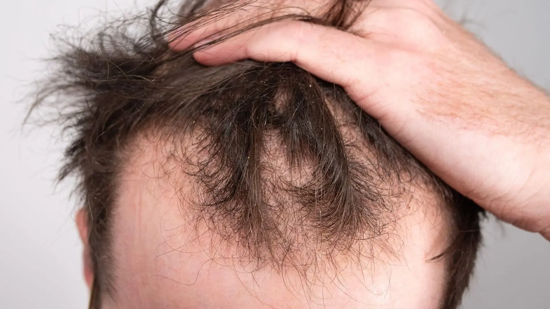 men hair loss